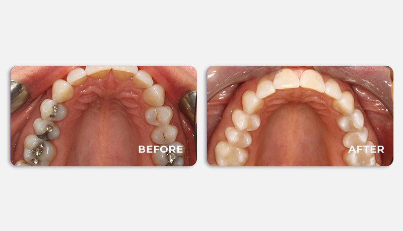 before and after treatment at Water Tower Dental Care