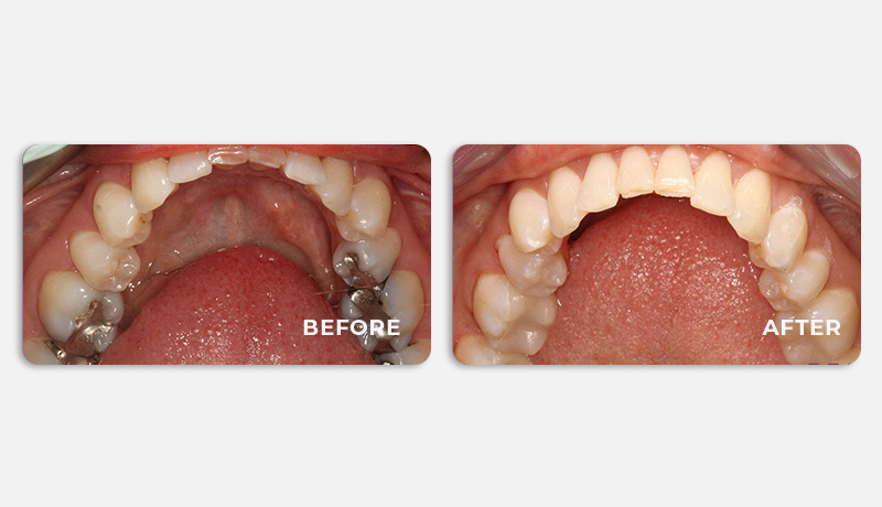 before and after treatment at Water Tower Dental Care
