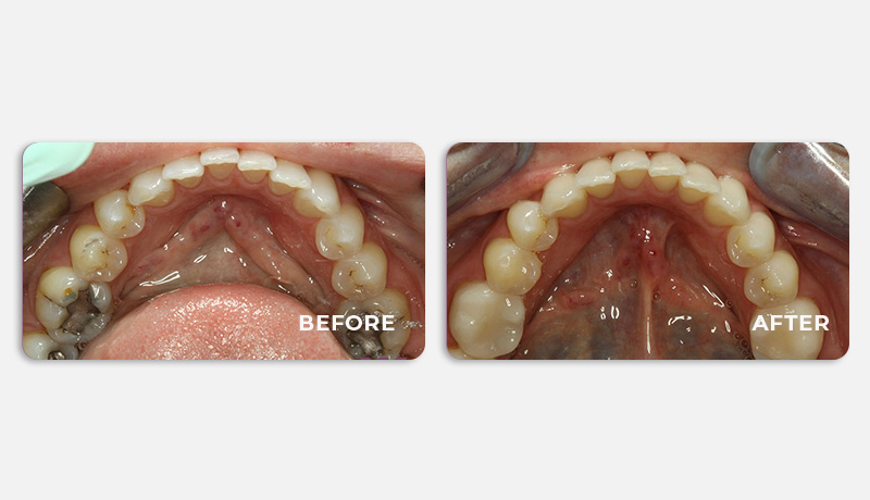 before and after treatment at Water Tower Dental Care