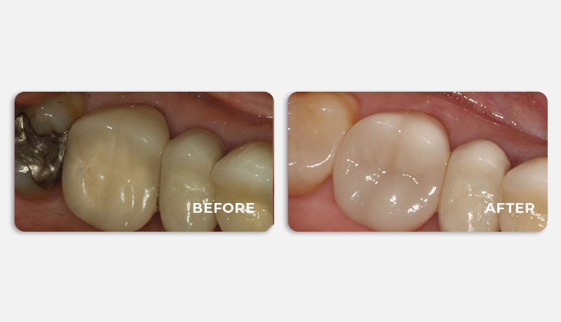 before and after treatment at Water Tower Dental Care