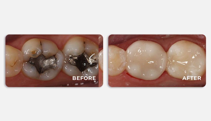 before and after treatment at Water Tower Dental Care