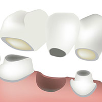 Dental bridge illustration showing multiple crowns connected to fill the gap of missing teeth, relevant to dental care options.