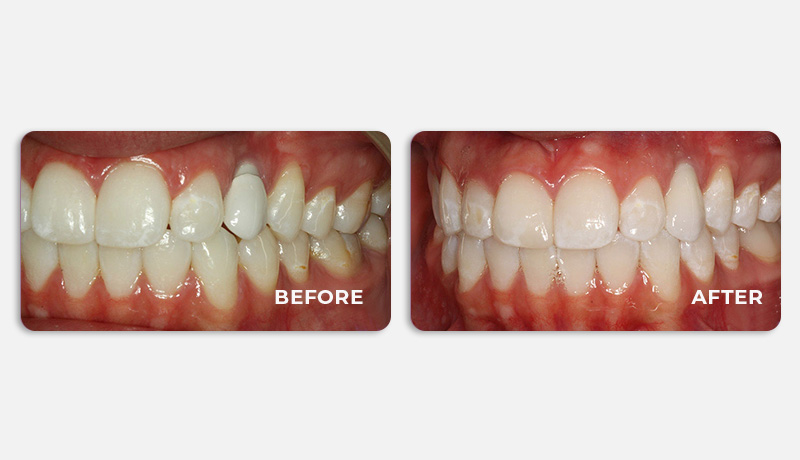 before and after treatment at Water Tower Dental Care