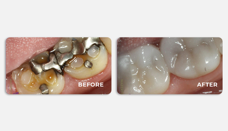 before and after treatment at Water Tower Dental Care