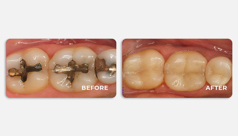 before and after treatment at Water Tower Dental Care
