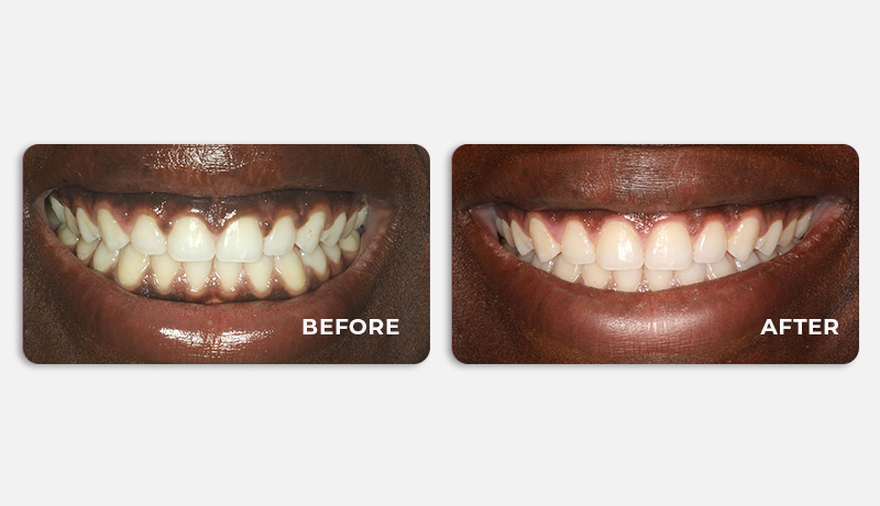 before and after treatment at Water Tower Dental Care