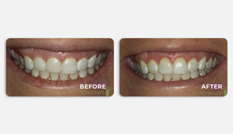 before and after treatment at Water Tower Dental Care