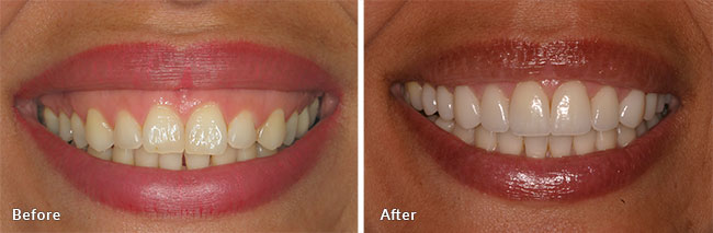 before and after gummy smile treatment
