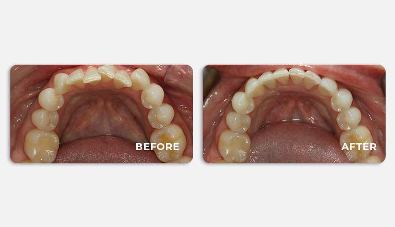 before and after treatment at Water Tower Dental Care