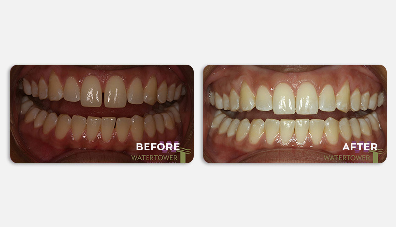 before and after treatment at Water Tower Dental Care