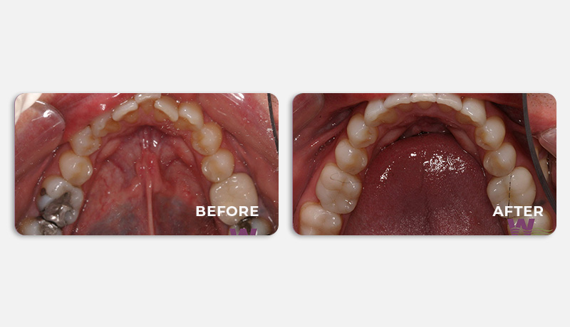 before and after treatment at Water Tower Dental Care