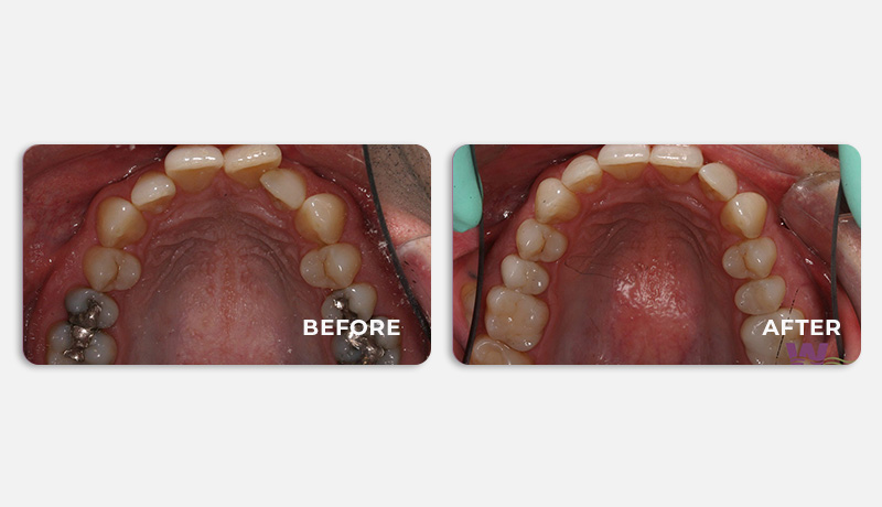 before and after treatment at Water Tower Dental Care