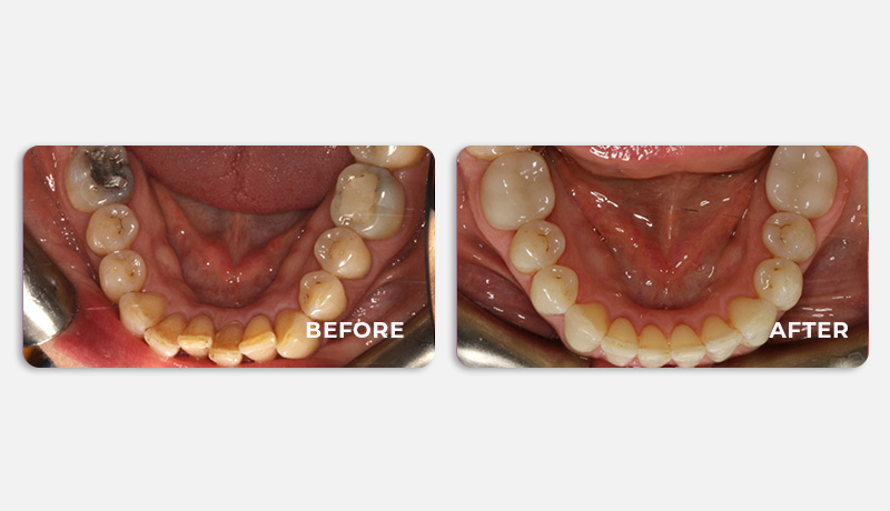 before and after treatment at Water Tower Dental Care