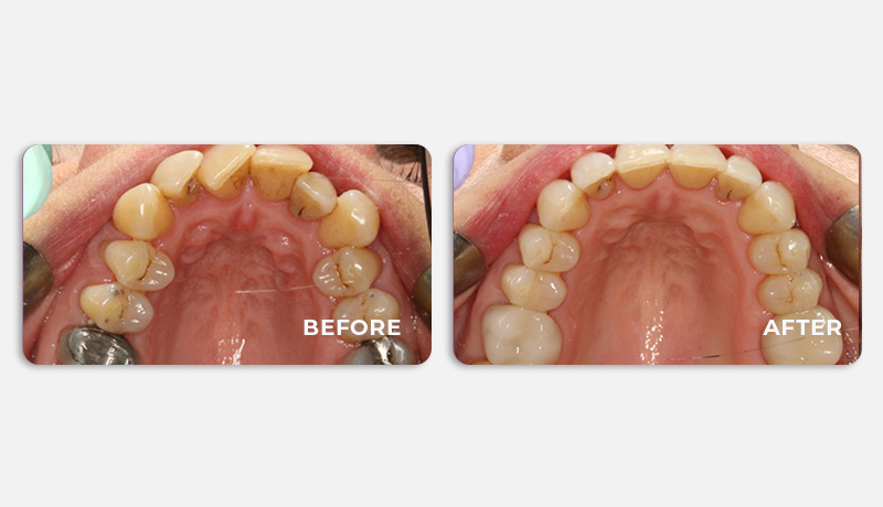 before and after treatment at Water Tower Dental Care
