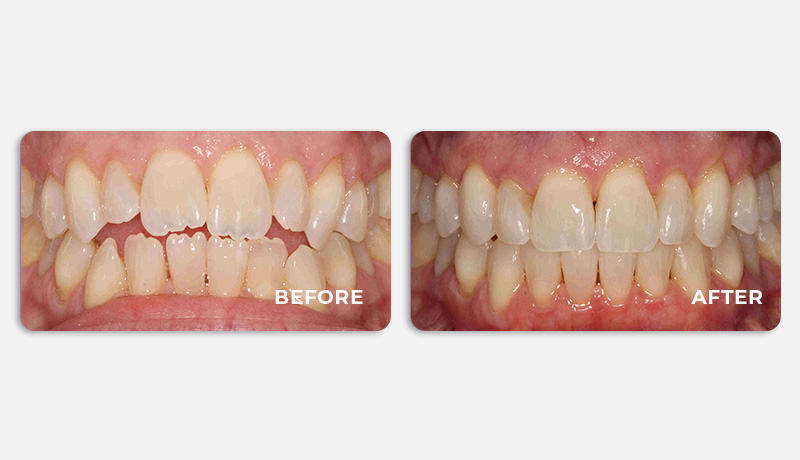 before and after treatment at Water Tower Dental Care