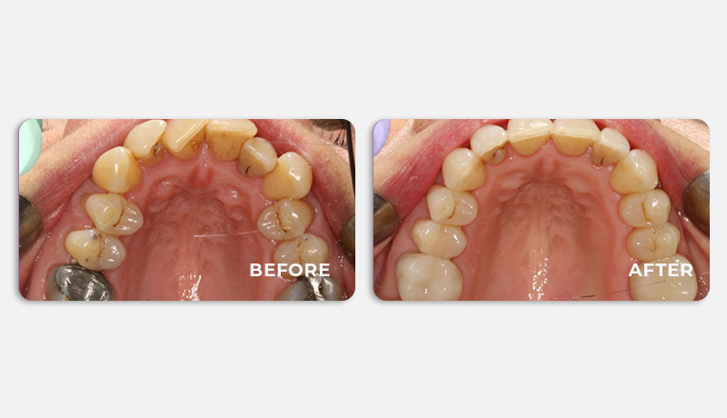 before and after treatment at Water Tower Dental Care