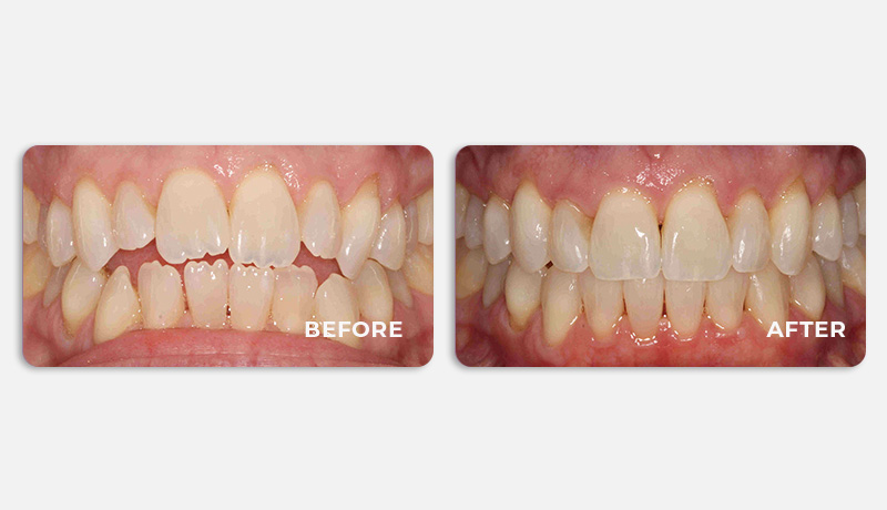 before and after treatment at Water Tower Dental Care