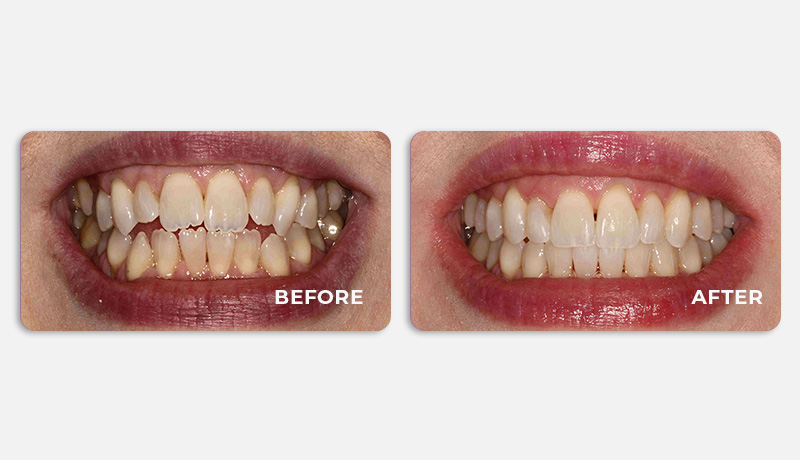 before and after treatment at Water Tower Dental Care