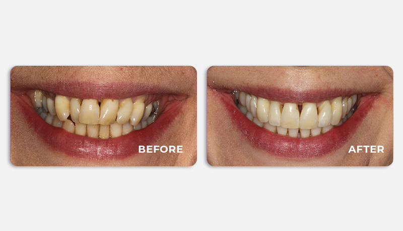 before and after treatment at Water Tower Dental Care