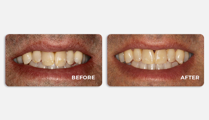 before and after treatment at Water Tower Dental Care
