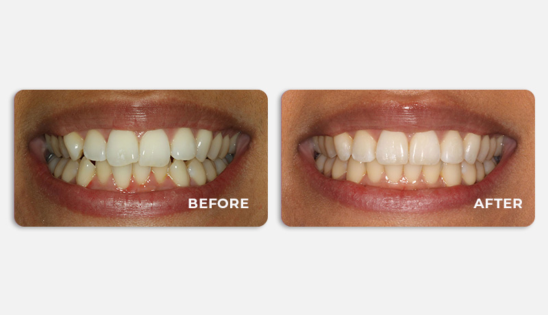 before and after treatment at Water Tower Dental Care