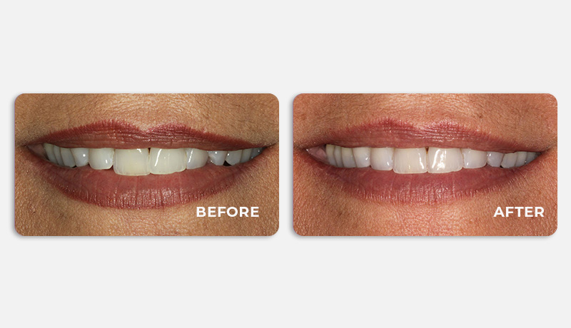 before and after treatment at Water Tower Dental Care
