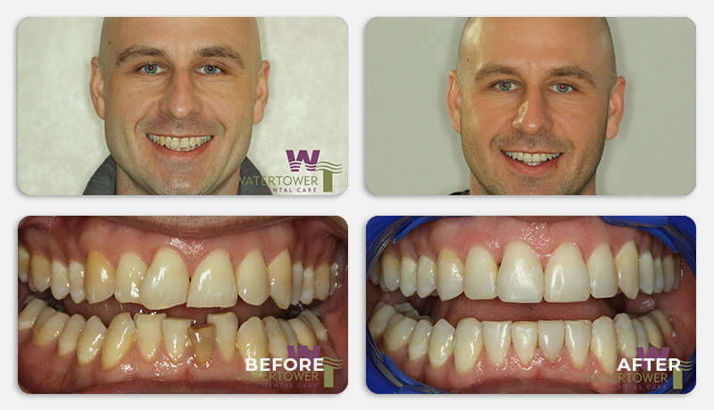 before and after treatment at Water Tower Dental Care