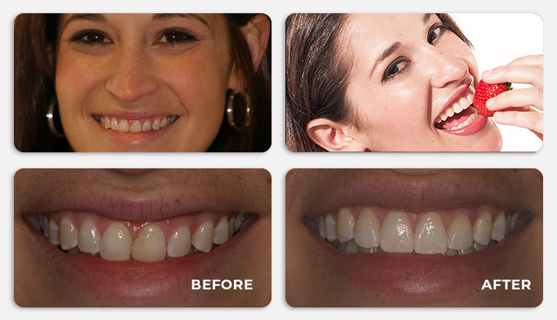 before and after treatment at Water Tower Dental Care