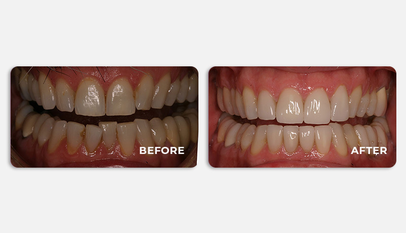 before and after treatment at Water Tower Dental Care