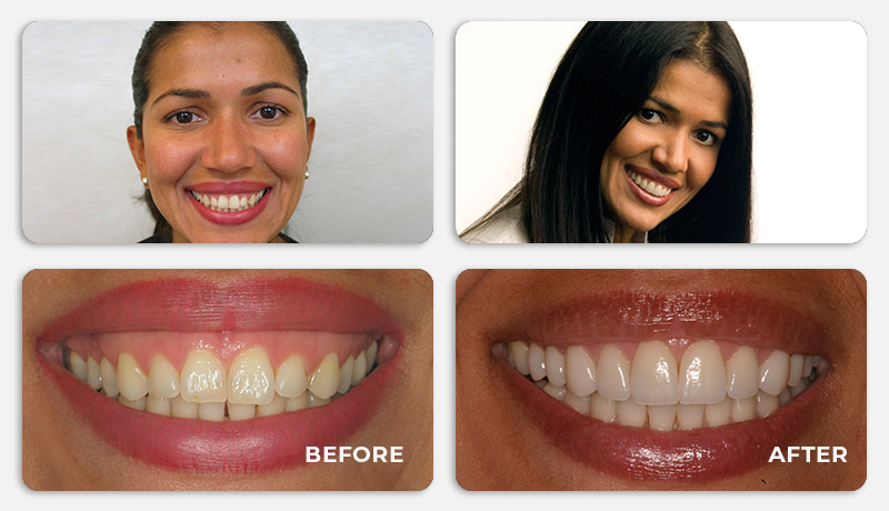 before and after treatment at Water Tower Dental Care