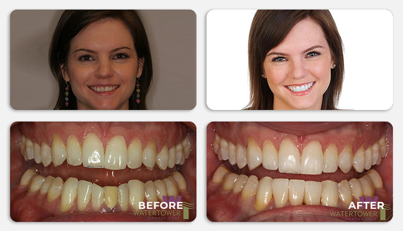 before and after treatment at Water Tower Dental Care
