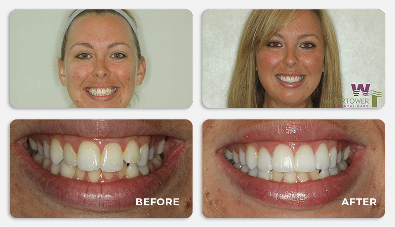 before and after treatment at Water Tower Dental Care