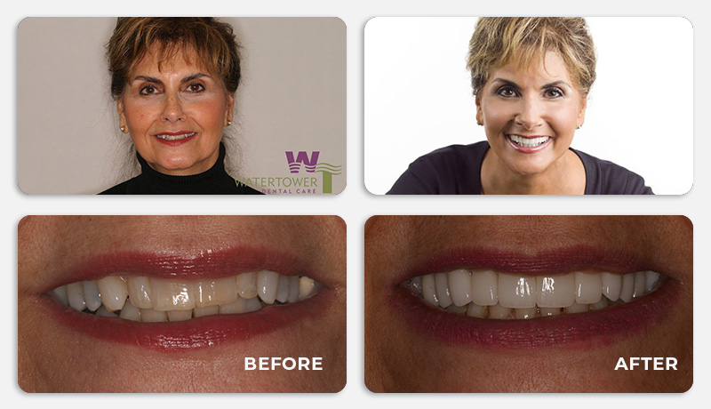 before and after treatment at Water Tower Dental Care