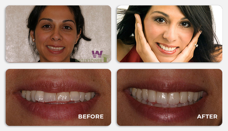 before and after treatment at Water Tower Dental Care