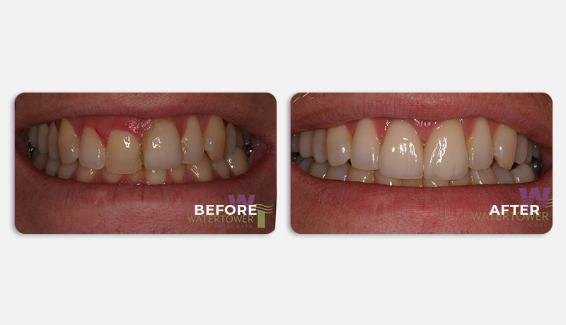 before and after treatment at Water Tower Dental Care