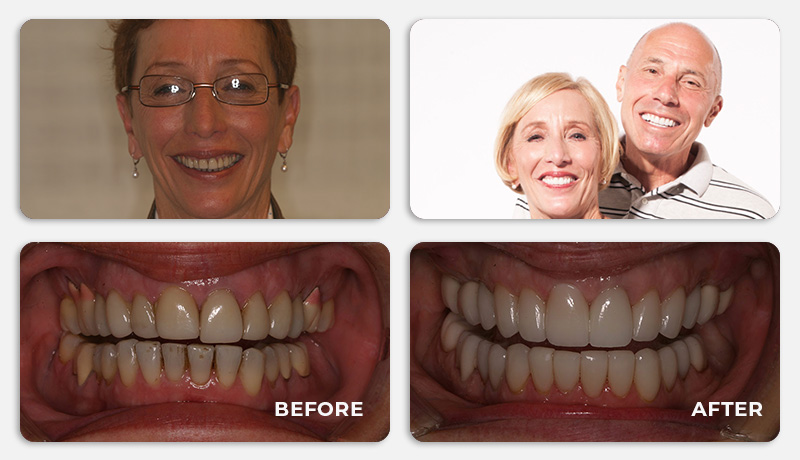 before and after treatment at Water Tower Dental Care
