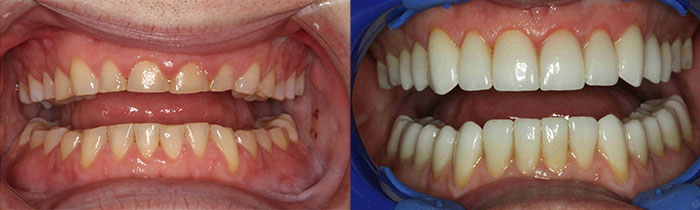 before and after short teeth treatment