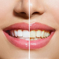 before and after teeth whitening