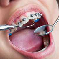 Adult mouth with braces and dental tools, illustrating orthodontic treatment for teeth straightening.