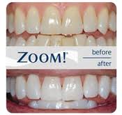 before and after treatment at Water Tower Dental Care