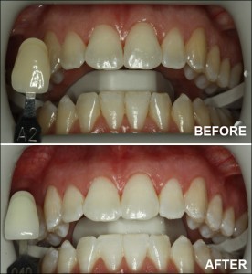 Zoom teeth whitening before and after