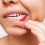 gum disease